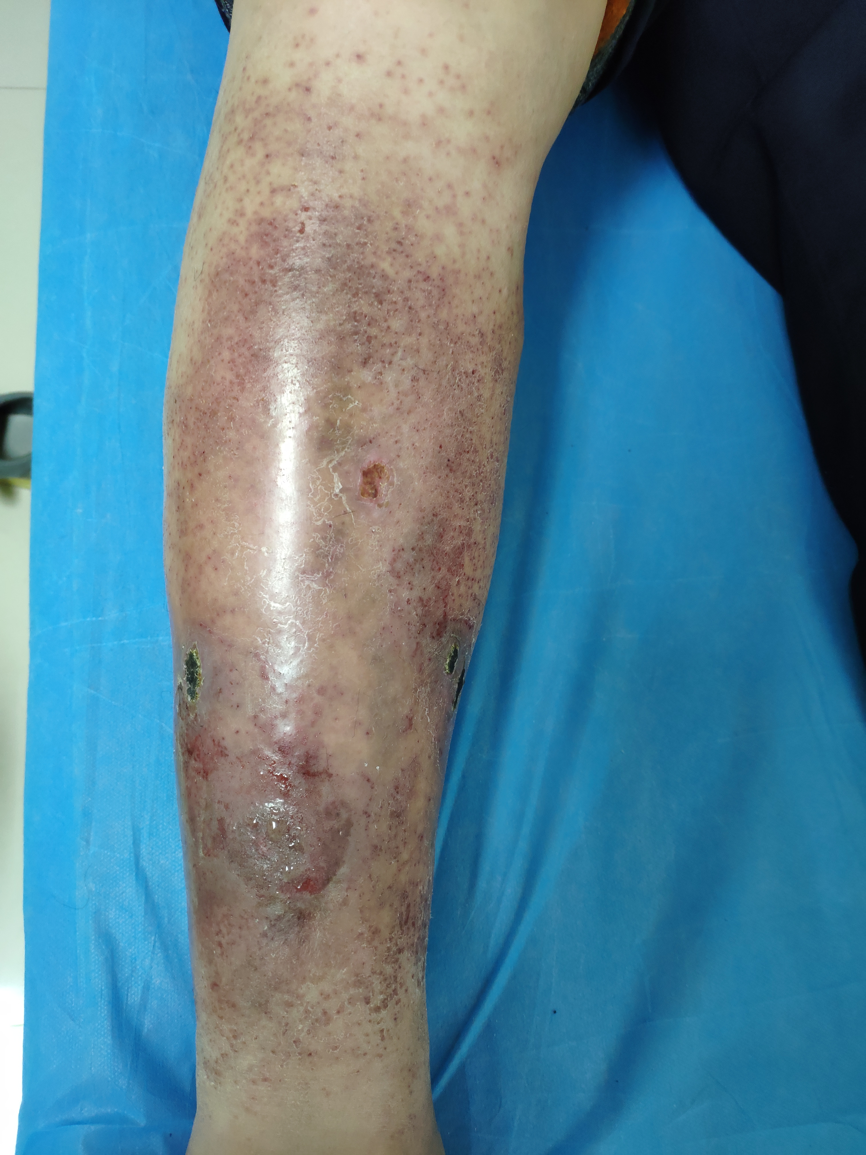 皮肤溃疡长期不愈合挂哪个科,皮肤出水溃烂看什么科