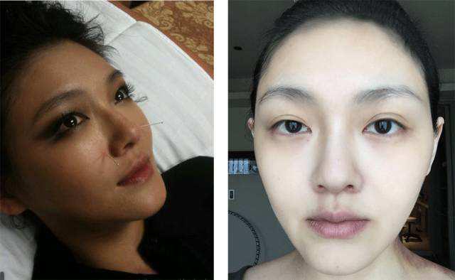 微整形美白针,微整形是永久的吗