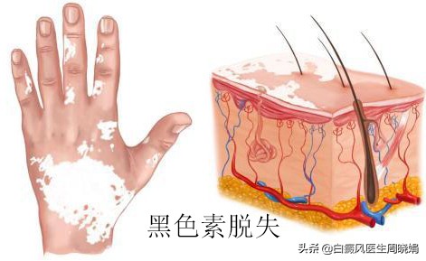手上长白块还掉皮怎么回事,手上长的白块是什么