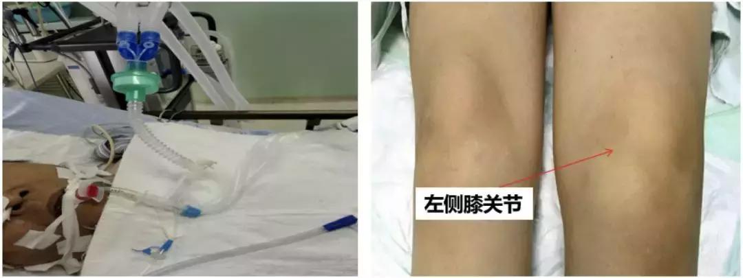 万古霉素治疗mrsa疗程,万古霉素用于mrsa的作用机制