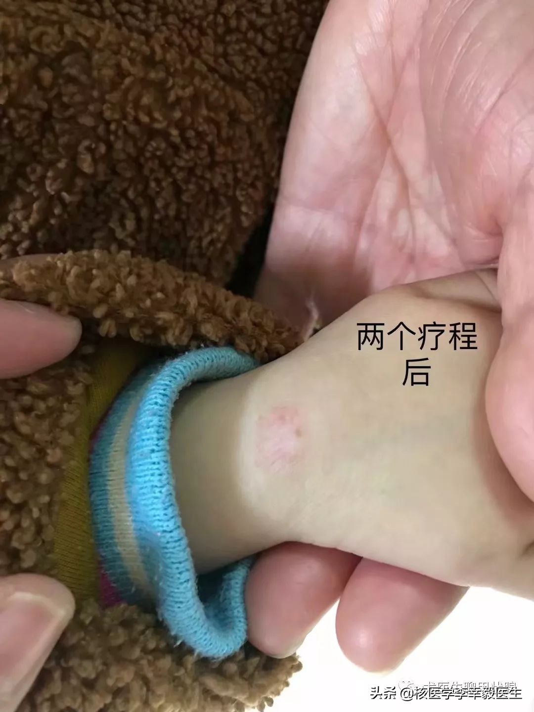 瘢痕疙瘩毛细血管扩张,毛细血管瘤治疗后留疤怎么去除