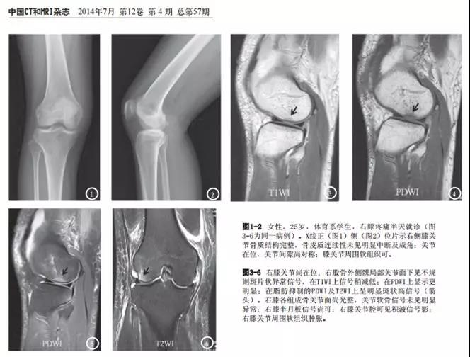 关节疼痛护膝可以缓解吗,关节疼痛带来的伤害