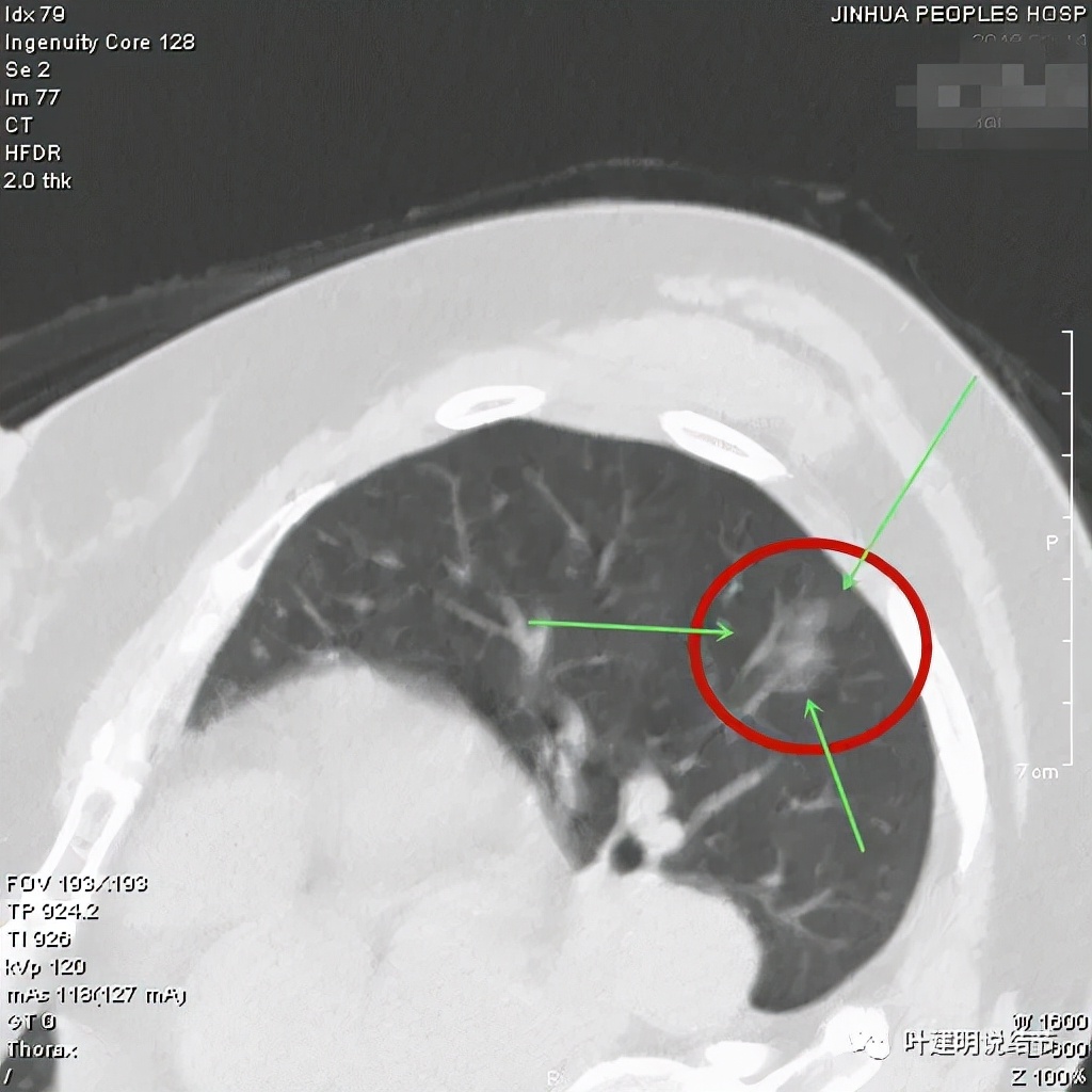 怎样从病理报告看是不是原位癌,原位腺癌切除子宫要开刀吗