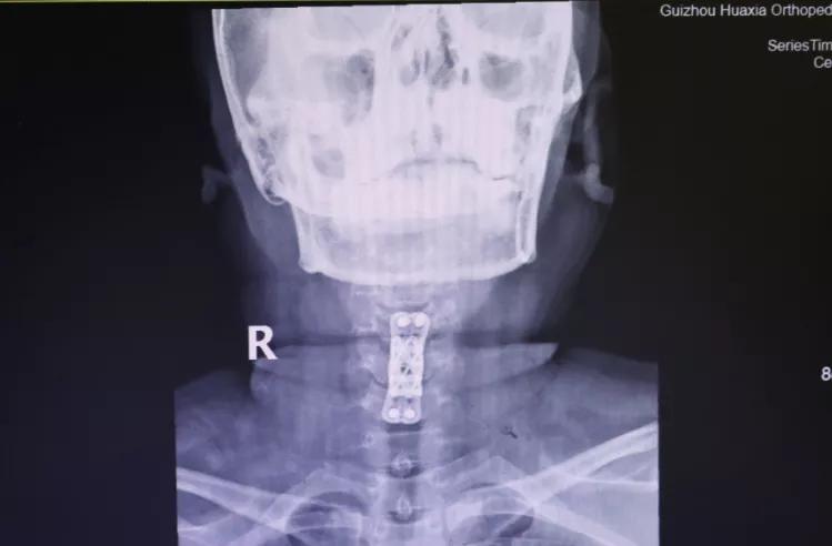 手痛手麻手指无力真相竟是颈椎病,颈椎病手麻手指有针刺感