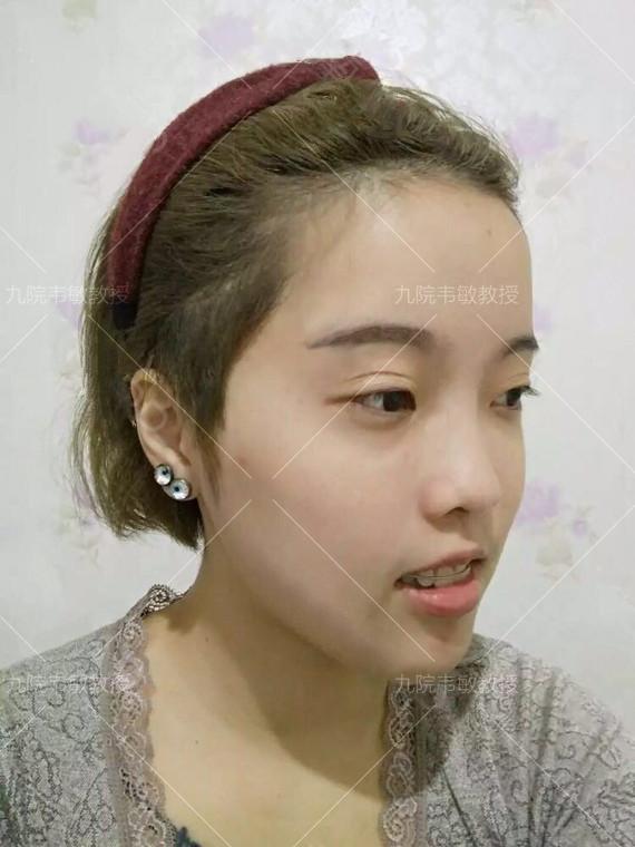 假体隆鼻科普之膨体隆鼻,膨体隆鼻整形效果怎么样