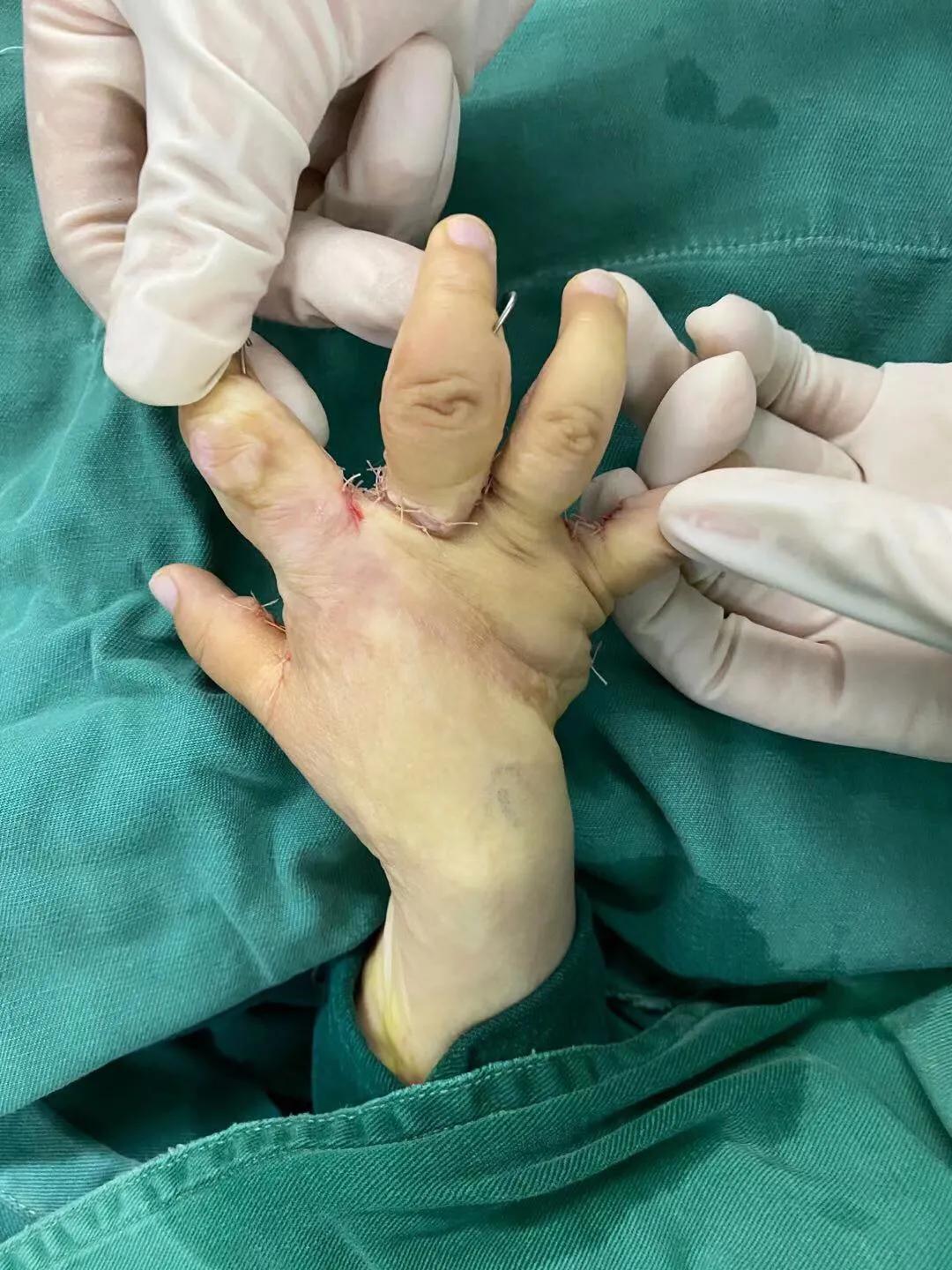 儿童烫伤的疤痕,三度烫伤疤痕为啥挛缩