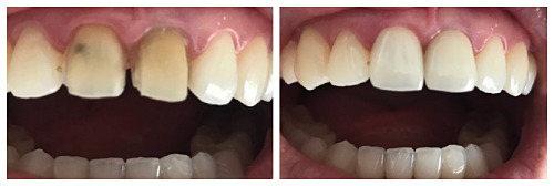 牙黄牙齿贴面全过程,哪里可以贴面修复黄牙