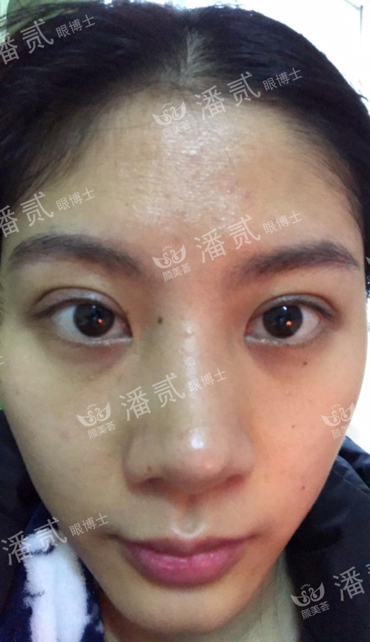 肿眼泡抽脂肪埋线双眼皮效果,肿眼泡割双眼皮长脂肪