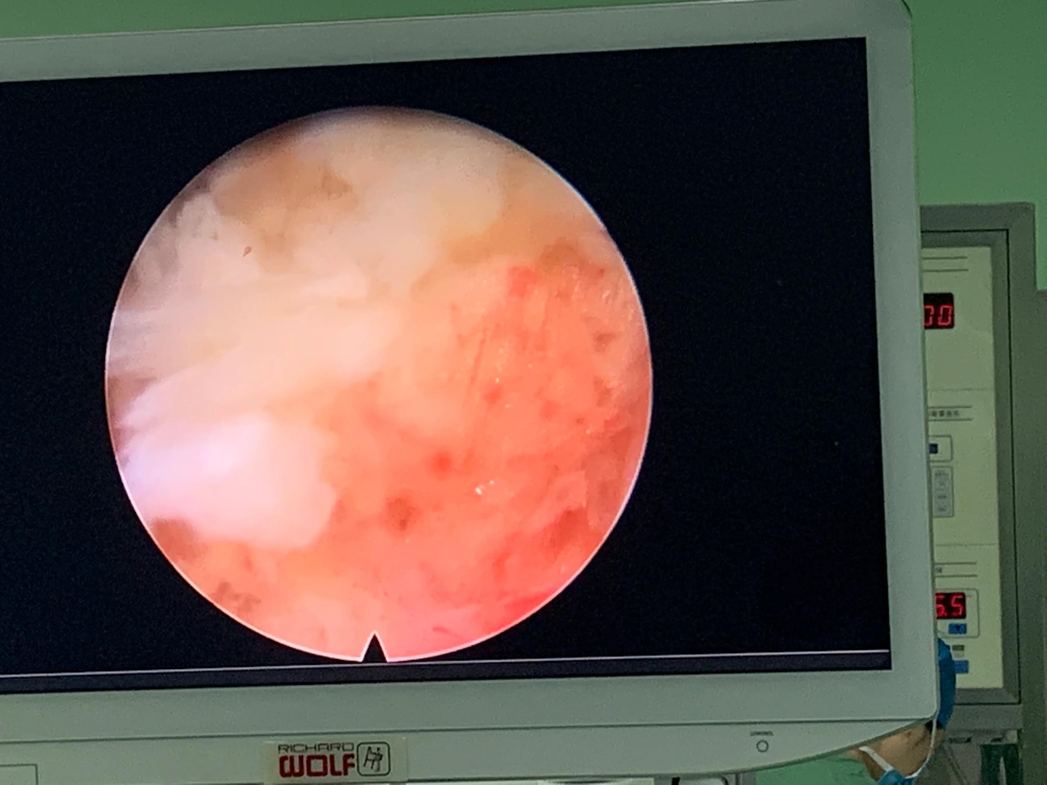 椎间孔镜术后腰痛症状多久消失,盘源性腰痛手术后易复发吗