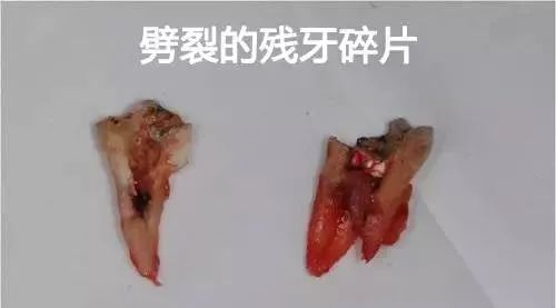 已经有牙洞了怎么根管治疗,牙髓腐烂坏死再做根管治疗会痛吗