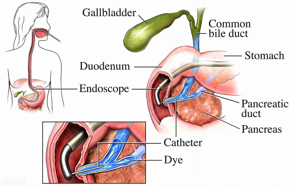 胆管放金属支架再次堵塞怎么办,胆管支架后反复发烧怎么办