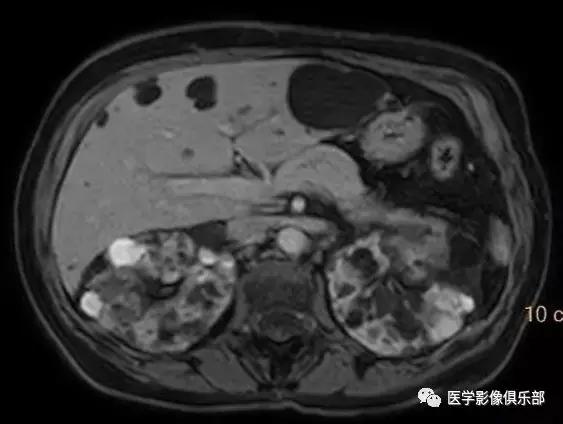 双肾多发小囊肿到底是不是多囊肾,肾多发囊肿与多囊肾的超声鉴别