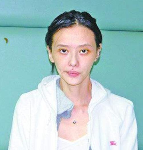 靠袒胸搏出位，3次吸毒被抓，如今患癌的她为保命切除5个器官