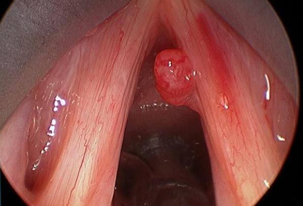 多发息肉不容易癌变,身上哪些部位长息肉会癌变