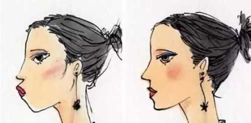 贵族手术的好处,鼻基底手术失败凹陷怎么改善