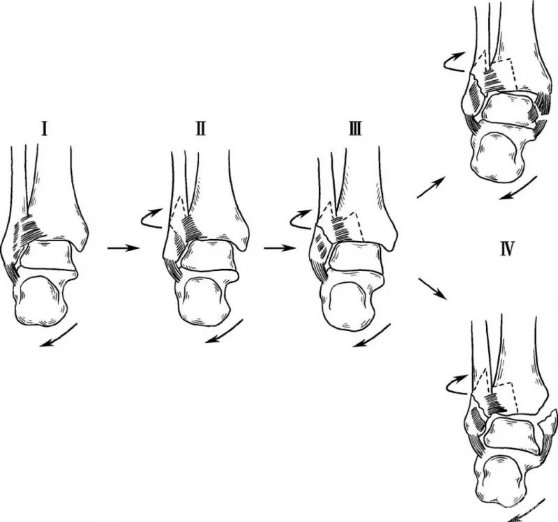骨折闭合复位髓内钉内固定术,骨折闭合复位