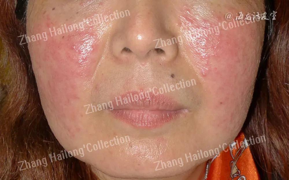 常见的脸部皮肤病有哪些,面部皮肤病辨别图解