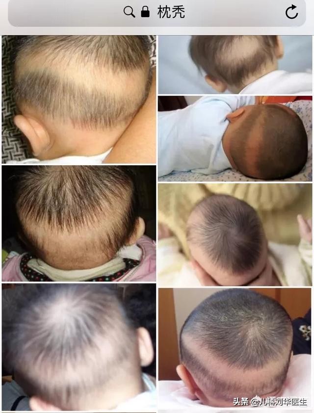 宝宝有枕秃是什么意思,孩子枕秃查血不缺钙怎么办