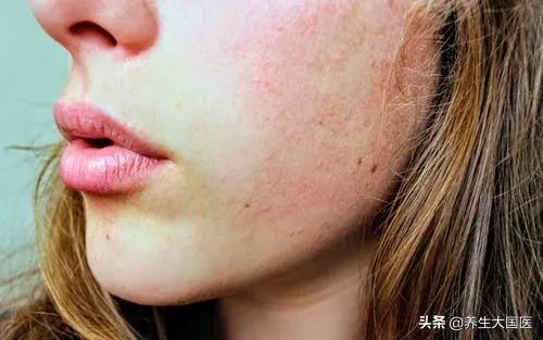 嘴唇干裂口干口渴是怎么回事,嘴唇干燥口渴怎么治