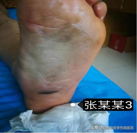 李氏砭法刮痧直播,李氏虎符铜砭刮痧治腰椎间盘突出