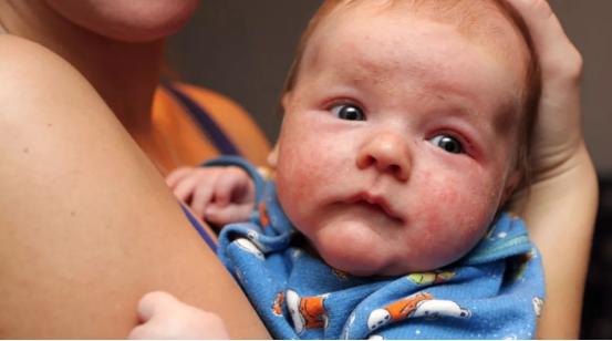 春季婴儿湿疹高发日常护理很关键,哺乳期孩子湿疹家长需要排湿气吗