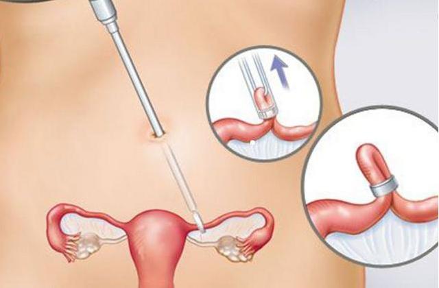 关于女性结扎,女的结扎是不是不可逆的