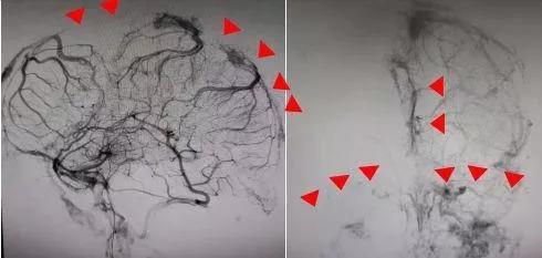 26岁小伙熬夜加班,23岁小伙熬夜突然头痛