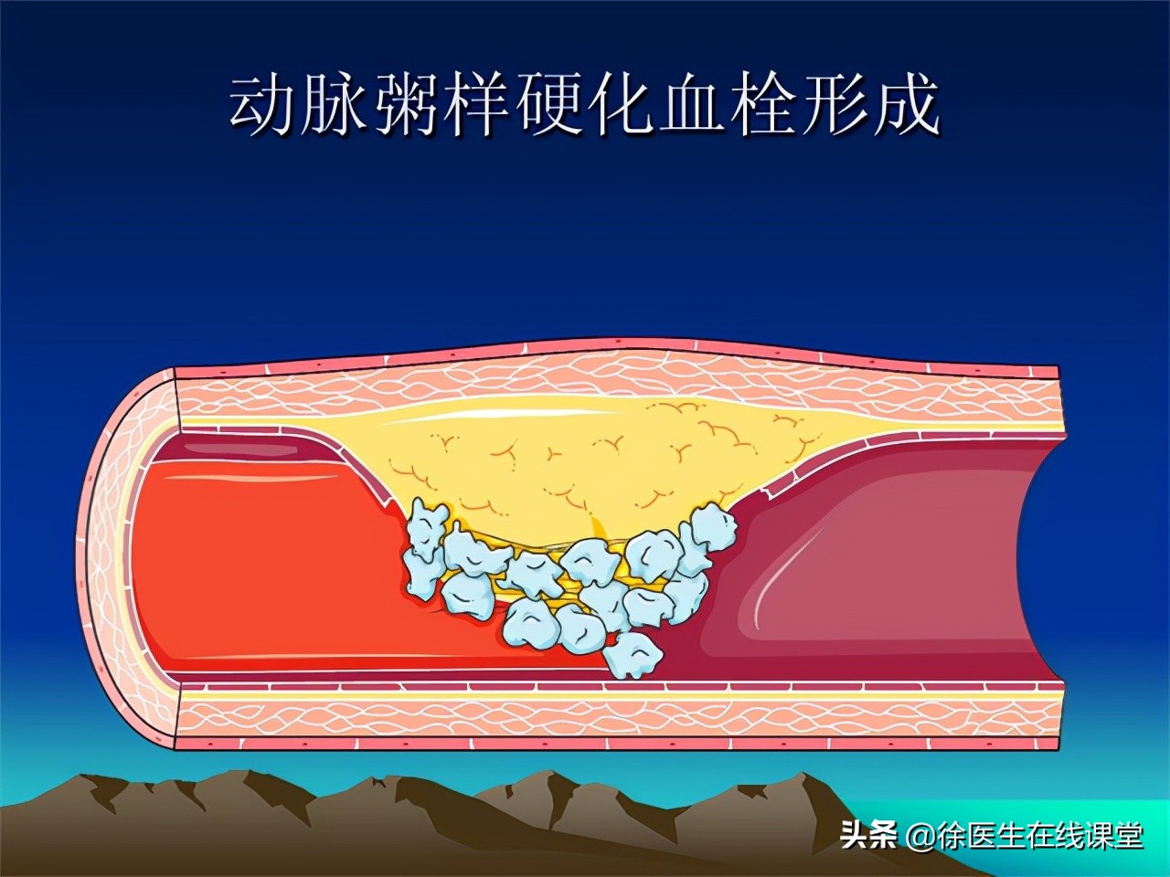 血粘度高吃药管用吗,血粘度偏高吃丹参片行吗