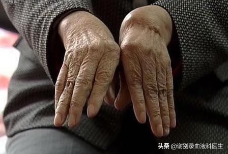 类风湿性关节炎贫血机制,类风湿性关节炎致贫血