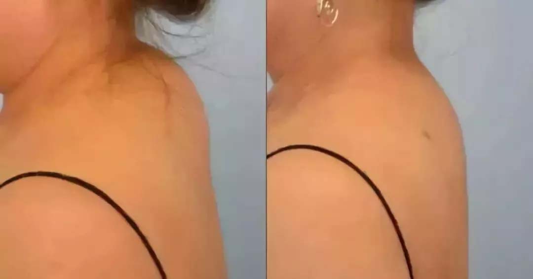 富贵包往往不是真的富贵包,富贵包的形成原因和危害