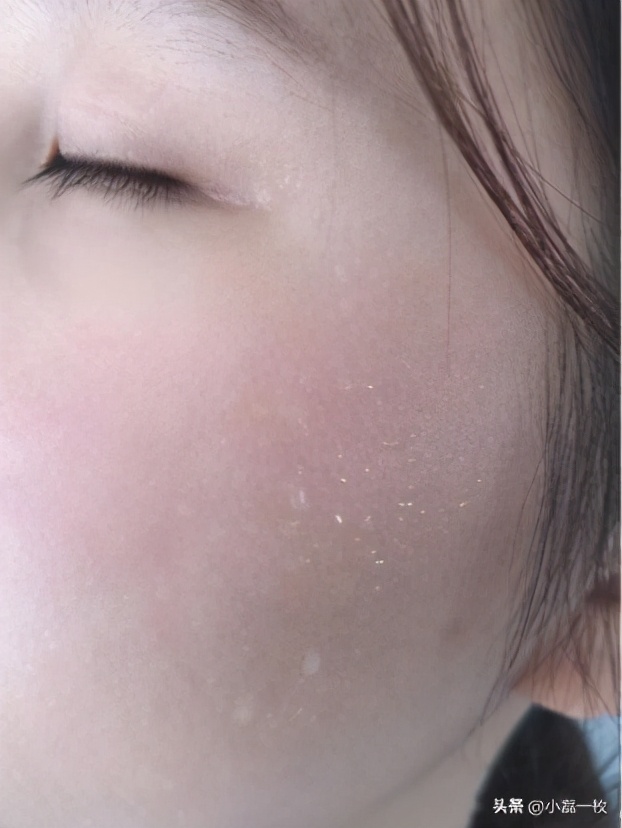 刷酸后爆痘持续多久,刷酸爆痘怎么处理