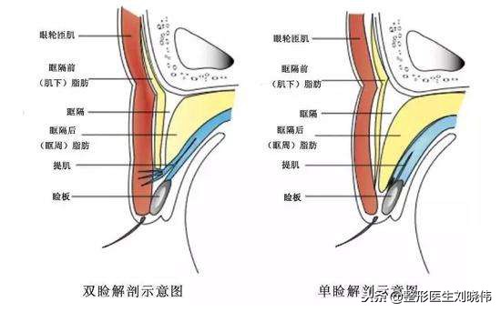 眼睛手术的坑,不要往里面跳了