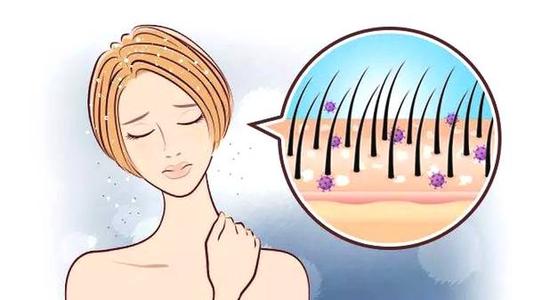 樊哥:为什么每天洗头还会有头皮屑?