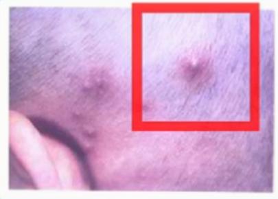 婴儿去热痱子怎么物理降温,宝宝热出痱子凉快了也不消失