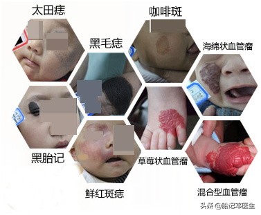 面容杀手,常见胎记的类型
