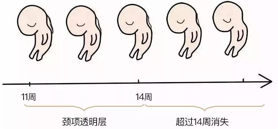 什么是NT检查？NT检查必须要做吗？NT检查有哪些注意事项？