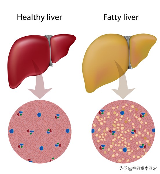 消除脂肪肝的克星,脂肪肝中医和西医哪个治疗效果好
