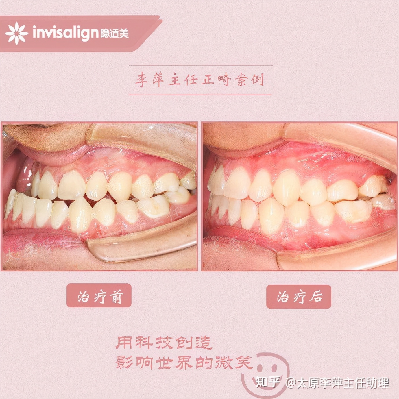 重度拥挤矫正牙齿适合隐形牙套吗,广州成人牙齿矫正推荐隐形牙套