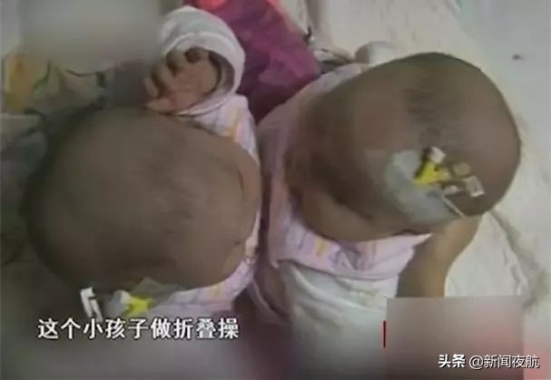坐骨连体双胞胎多大分离,中国首例坐骨婴儿手术成功完整版