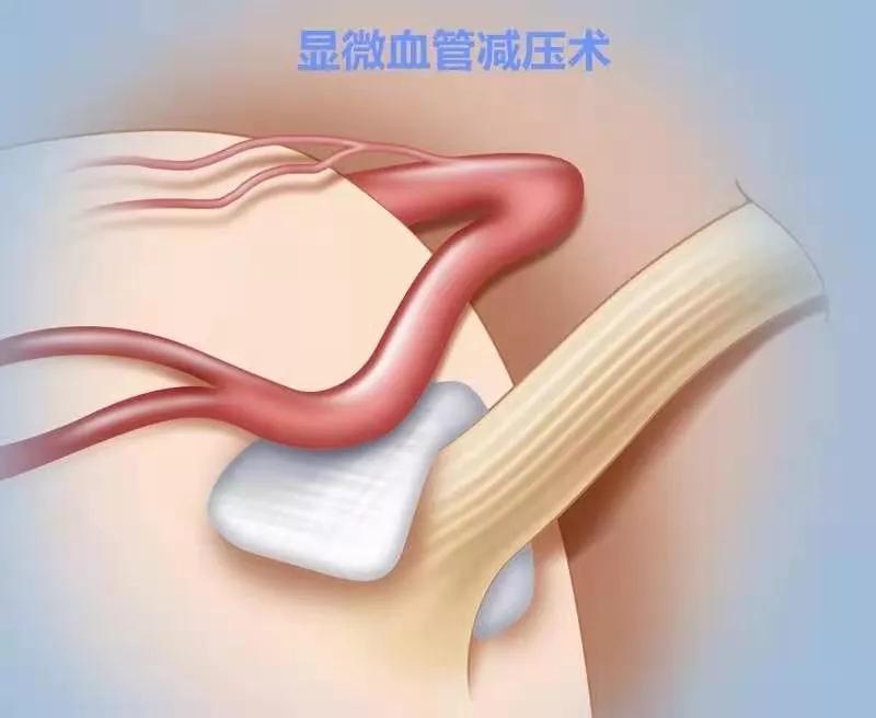 面肌痉挛通过合理习惯可以自愈吗,如何治疗面肌痉挛