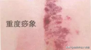 刮痧后的痧印情况比较分析总结，很全面，收藏起来学习