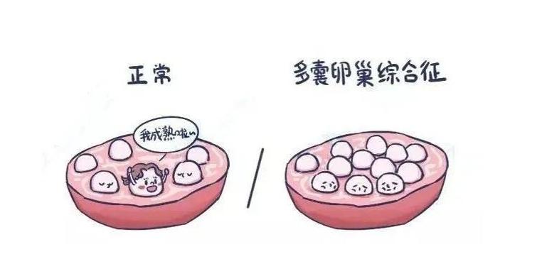 b超显示卵泡多就是多囊卵巢么,卵巢内有10-12个卵泡算多囊吗