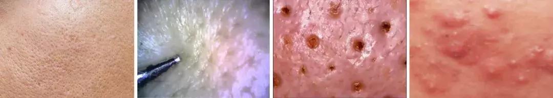 大油皮为啥还起皮,油皮是什么原因导致的怎么解决