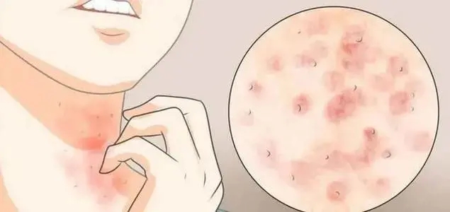 哺乳期神经性皮炎治疗方法,神经性皮炎针灸方法