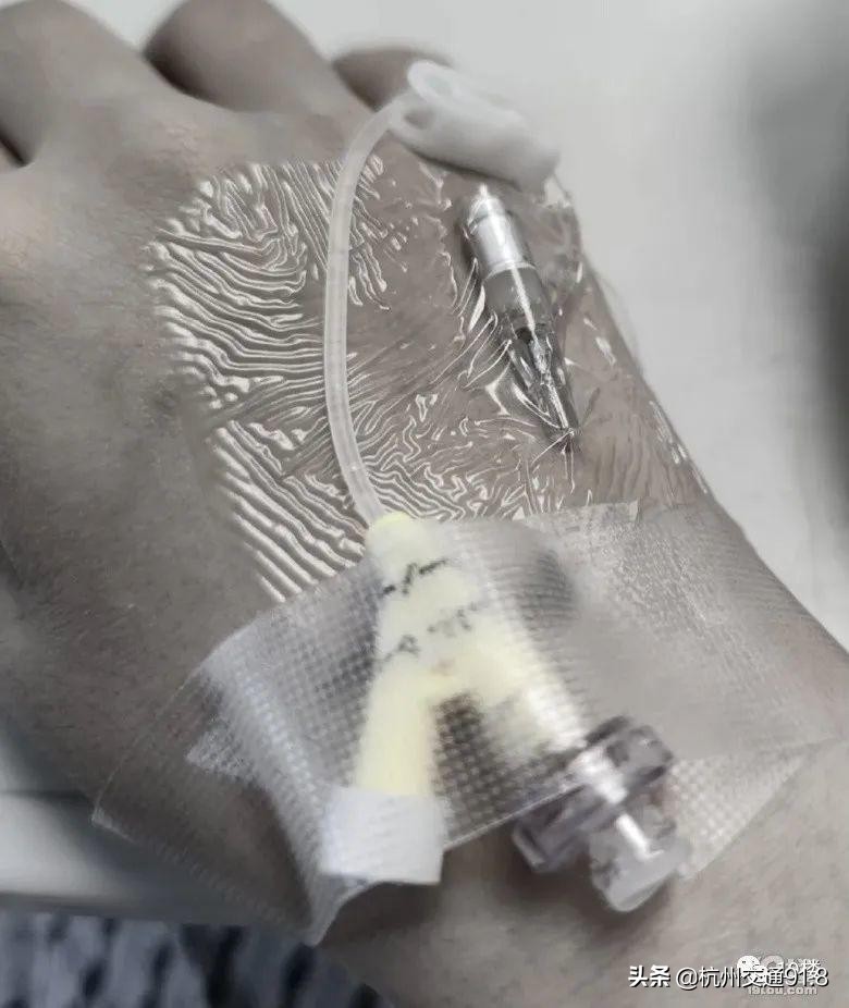 90后姑娘熬夜10年长出老年斑,杭州姑娘熬夜