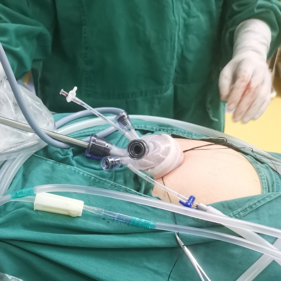 女性单孔腹腔镜手术,贵州省单孔腹腔镜