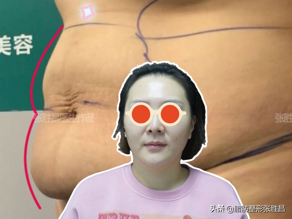 产后胖宝妈,产后肚子脂肪厚怎么减肥腹肌分离