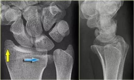 特殊骨折类型,特殊骨折体征
