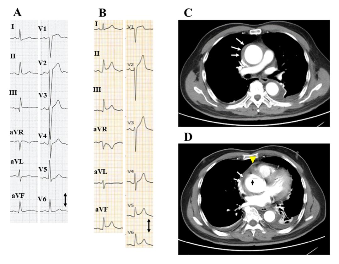 心包炎和主动脉夹层的区别,急性主动脉夹层的发生原因是什么