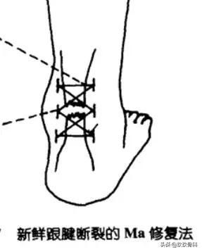 跟腱断裂的确诊方法,超详细跟腱断裂的诊断与治疗